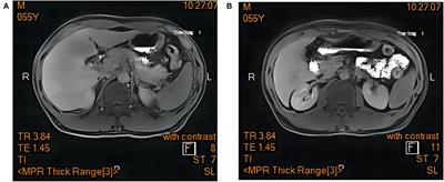 Herb-induced hepatitis secondary to artemisinin: A case report